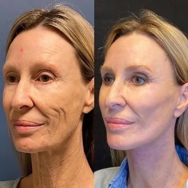 Botox Ansiktsserum by Trendy Mates